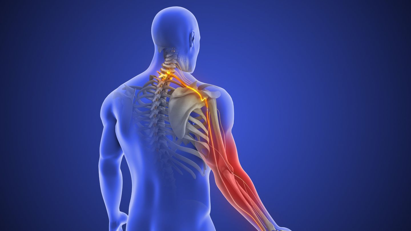 Three-dimensional illustration of a nerve running from the neck into the arm, highlighted where it causes arm pain.